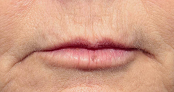 55-64 year old woman treated with Volbella for lip line smoothing after 3810398