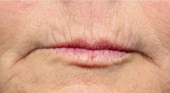 55-64 year old woman treated with Volbella for lip line smoothing before 3810398