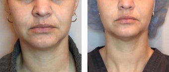 35-44 year old woman treated with Injectable Fillers before 2975962