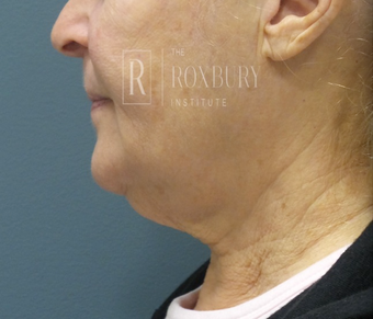65-74 year old woman treated with Non-Surgical Neck Lift before 3777573