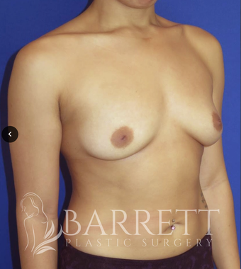 18-24 year old woman treated with Breast Implants 3584674