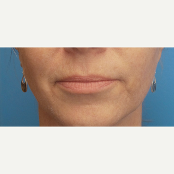 56 year old woman treated with Restylane Silk before 3685457