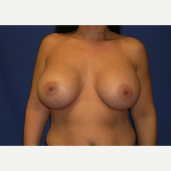 45-54 year old woman treated with Breast Augmentation after 3220064