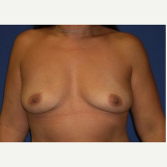 45-54 year old woman treated with Breast Augmentation before 3220064