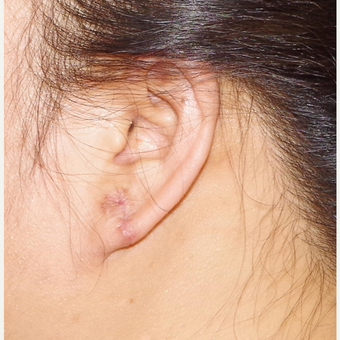 18-24 year old woman treated with Ear Lobe Surgery after 3741677