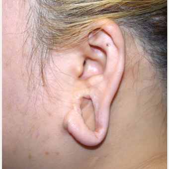 18-24 year old woman treated with Ear Lobe Surgery before 3741677