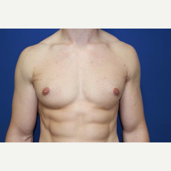 25-34 year old man treated with Nipple Surgery after 3066148