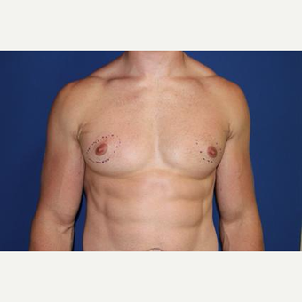 25-34 year old man treated with Nipple Surgery before 3066148