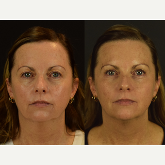 Non-Surgical Rejuvenation with PDO Threads before 3645136