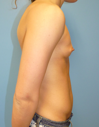 Breast Augmentation before 1579777