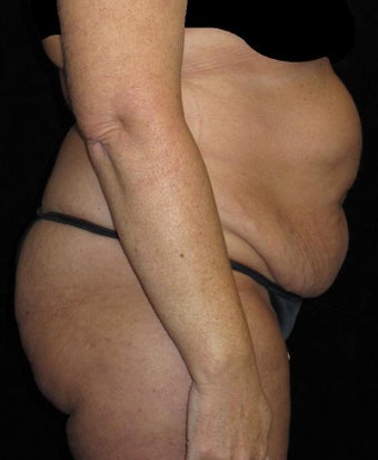 45 year old woman treated with Tummy Tuck 3251701