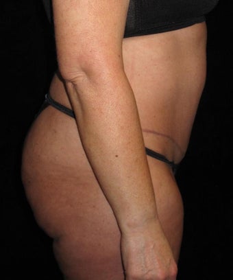 45 year old woman treated with Tummy Tuck 3251701