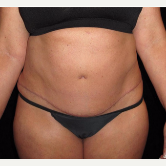 45 year old woman treated with Tummy Tuck after 3251701