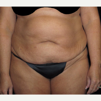 45 year old woman treated with Tummy Tuck before 3251701