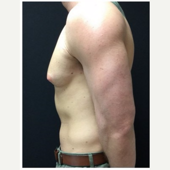 25-34 year old man treated with Male Breast Reduction before 3185985