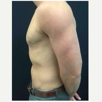 25-34 year old man treated with Male Breast Reduction after 3185985