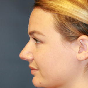 25-34 year old woman treated with Rhinoplasty before 3559760
