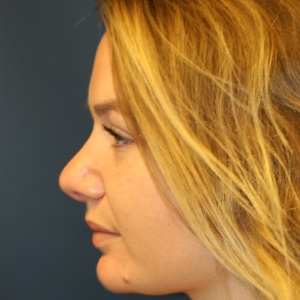 25-34 year old woman treated with Rhinoplasty after 3559760