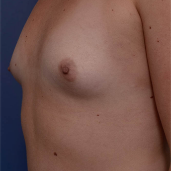 25-34 year old woman treated with Breast Augmentation before 3766826