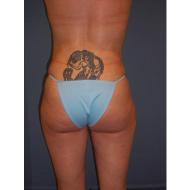 Buttock Accentuation after 1172423