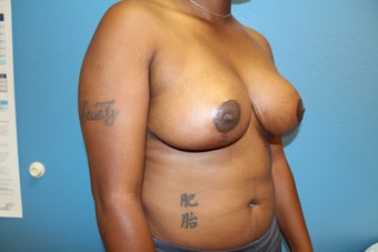 35-44 year old woman treated with Breast Reduction 2717131