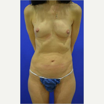 49 year old woman treated with Breast Reconstruction after 3725297