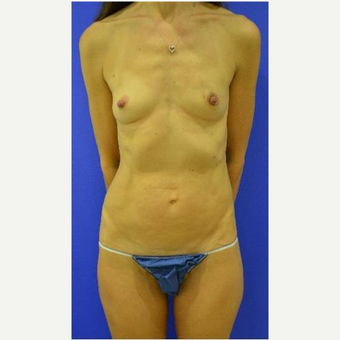 49 year old woman treated with Breast Reconstruction before 3725297