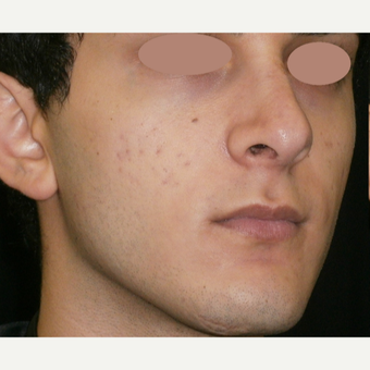 17 or under year old man treated with ProFractional Laser before 3150270