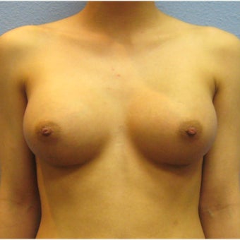 Breast Augmentation, Breast Implants after 1643518