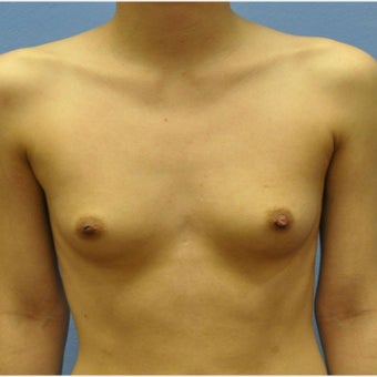 Breast Augmentation, Breast Implants before 1643518