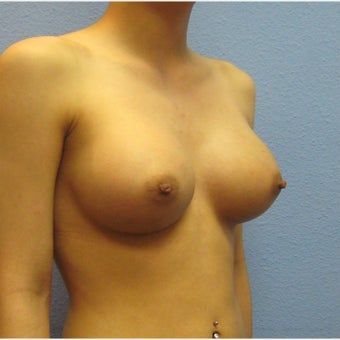 Breast Augmentation, Breast Implants 1643518