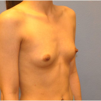 Breast Augmentation, Breast Implants 1643518