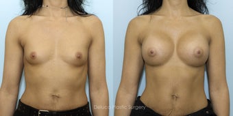 Breast Augmentation with 375cc High Profile Silicone Prosthesis before 1520529
