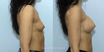 Breast Augmentation with 375cc High Profile Silicone Prosthesis 1520529