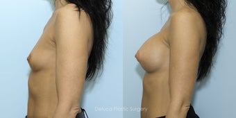 Breast Augmentation with 375cc High Profile Silicone Prosthesis after 1520529