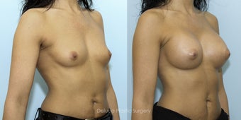 Breast Augmentation with 375cc High Profile Silicone Prosthesis 1520529