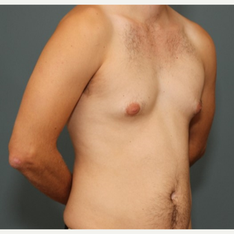 25-34 year old man requesting excision of gynecomastia before 3695440