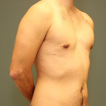 25-34 year old man requesting excision of gynecomastia after 3695440