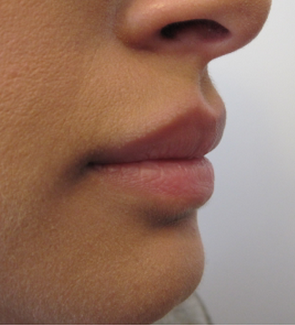 Lip Filler - Juvederm Volbella before 1305540
