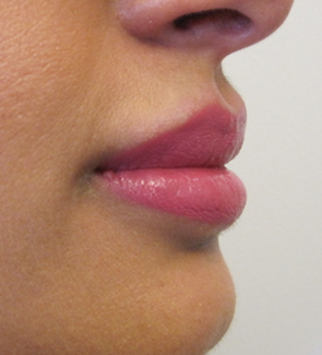 Lip Filler - Juvederm Volbella after 1305540