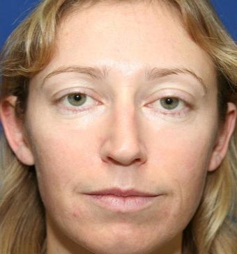 25-34 year old woman treated with Cheek Implants, Chin Implant, Nose Surgery and Fat Grafts 1950056