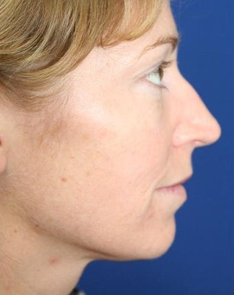 25-34 year old woman treated with Cheek Implants, Chin Implant, Nose Surgery and Fat Grafts before 1950056