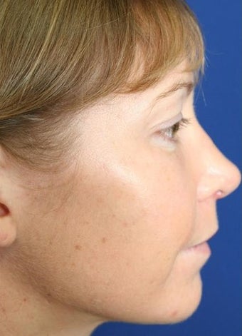 25-34 year old woman treated with Cheek Implants, Chin Implant, Nose Surgery and Fat Grafts after 1950056