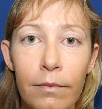 25-34 year old woman treated with Cheek Implants, Chin Implant, Nose Surgery and Fat Grafts 1950056