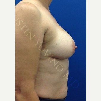 Breast Fat Transfer after 2791071