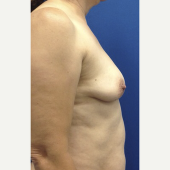 Breast Fat Transfer before 2791071
