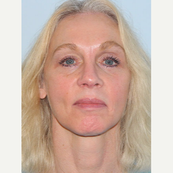 55-64 year old woman treated with Mini Lift, 4-Lid Blepharoplasty and Browlift after 3264833