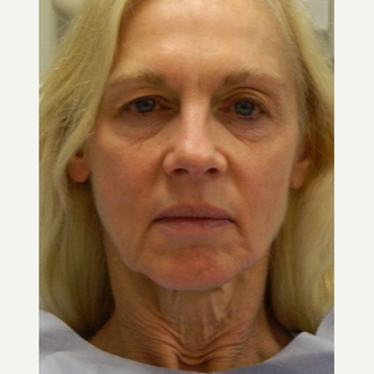 55-64 year old woman treated with Mini Lift, 4-Lid Blepharoplasty and Browlift before 3264833