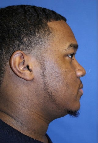 A young man with large underbite treated with Jaw Surgery (Orthognathic Surgery) 783712