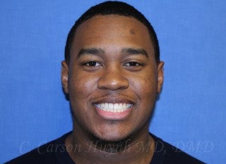 A young man with large underbite treated with Jaw Surgery (Orthognathic Surgery) after 783712